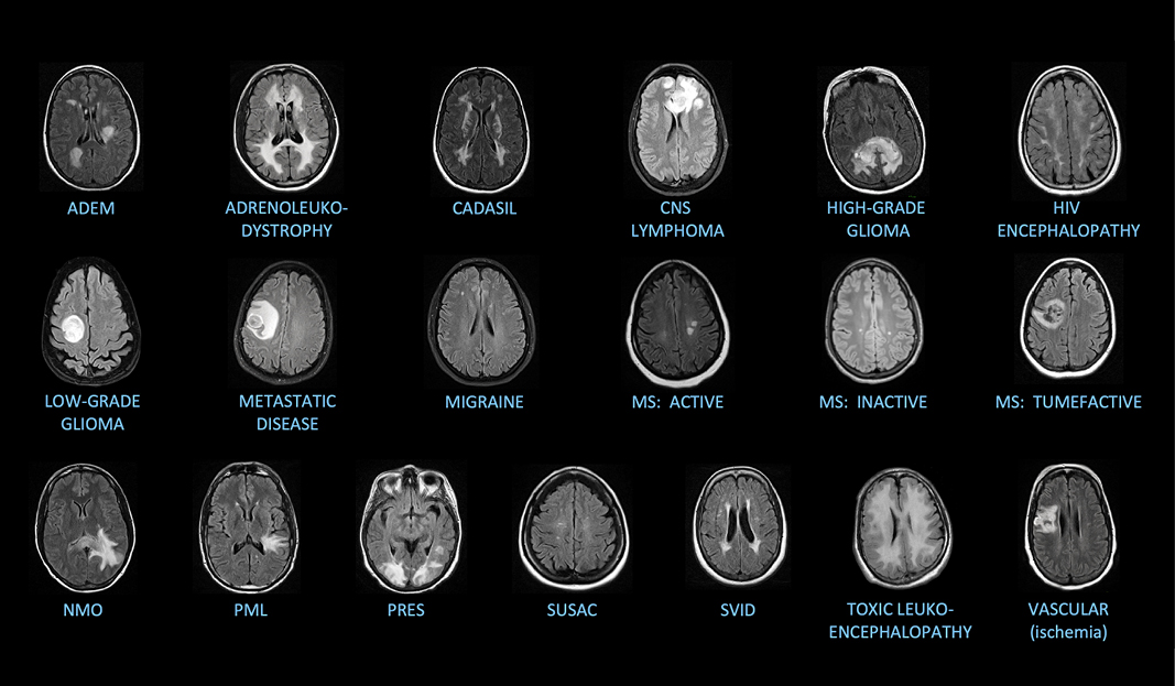 Brain diseases