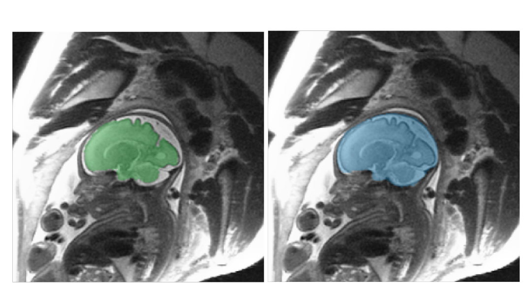 Fetal Brain individual